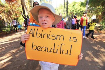 Young Albino Child holding an Albinism is Beautiful sign