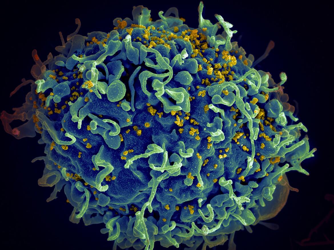 HIV virus seen under a microscope