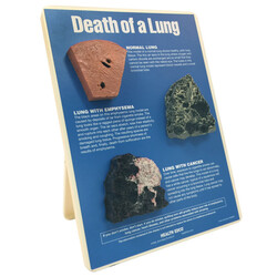 Examples of a normal lung,  lung with emphysema, and a lung with cancer. 